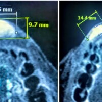 Venous malformation of the lip before and after a single session of direct stick embolization.