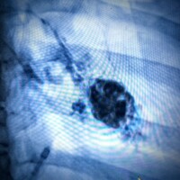 Direct stick embolization of a posterior trunk and pleural (lung) venous malformation.