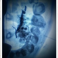 Combined therapy with superselective coli embolization of feeding artery and direct stick embolization of the nidus of a tongue AVM