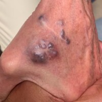Blue Rubber Bleb Nevus Syndrome of the left hand.
