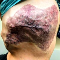 Classic features of CLOVES Syndrome of port wine stain, lipomatous overgrowth, and underlying venous malformation