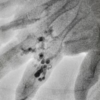 Direct stick embolization of a right index finger venous malformation