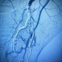 A right foot arteries malformation on selective angiography showing a large plantar nidus.