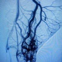 A right foot arteries malformation on selective angiography showing a large plantar nidus.