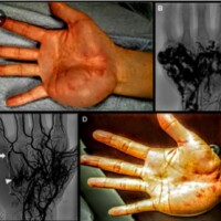 Massive hypothenar hand arteriovenous malformation before and after multifaceted treatment with transarterial onyx, direct stick onyx, and transvenous coil embolization.