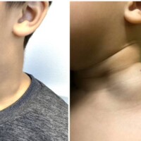Macrocystic lymphatic malformation cured following a single session of direct stick embolization with persistent results 12 months following treatment