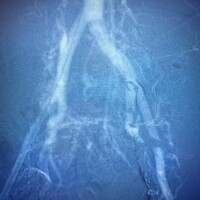 Pelvic arteriovenous malformation (in #13) after treatment.