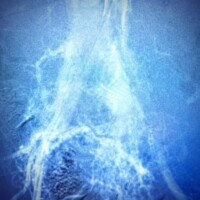 Massive high flow pelvic arteriovenous malformation causing high output cardiac failure and chronic supplemental oxygen dependence before a 3-stage outpatient embolization treatment.
