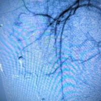 Severely symptomatic, focal AVM of the thigh cured following a single session of superselective glue embolization