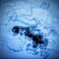 Superselective microcatheter angiography of a massive, ulcerated hand AVM.
