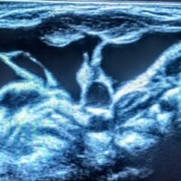 Multilobulated, macrocystic lymphatic malformation of the neck in a young child.  Separations and lobulations are classic features under ultrasound.