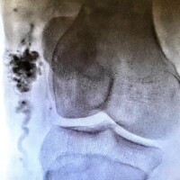 Selective venogram demonstrating a large para-patellar venous malformation.