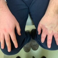 CLOVES Syndrome