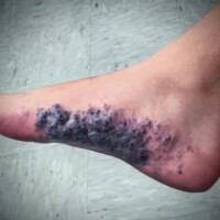 Glomuvenous malformation of the right plantar foot.