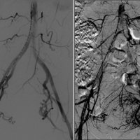 Aortogram demonstrating tortuous, enlarged, bilateral uterine arteries. Delayed, visceral phase angiogram outlines the extent and contour of the fibroid tumor.
