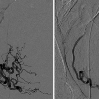 Right uterine artery, before and after fibroid embolization.