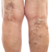 Female legs with swollen veins and varicose as vascular condition concept isolated on white studio background