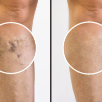 Person Leg With Varicose Veins And Capillaries Before And After Medical Treatment