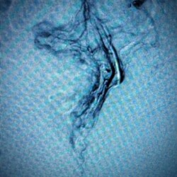 Bleeding high grade internal hemorrhoids, before and after coil and particulate embolization on an ambulatory basis in the office
