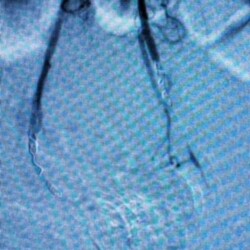 Bleeding high grade internal hemorrhoids, before and after coil and particulate embolization on an ambulatory basis in the office