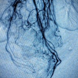 Bleeding high grade internal hemorrhoids, before and after coil and particulate embolization on an ambulatory basis in the office