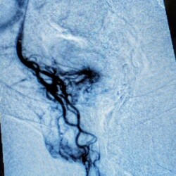 Bleeding high grade internal hemorrhoids, before and after coil and particulate embolization on an ambulatory basis in the office